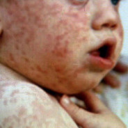 photo, closeup of child's face with Measles